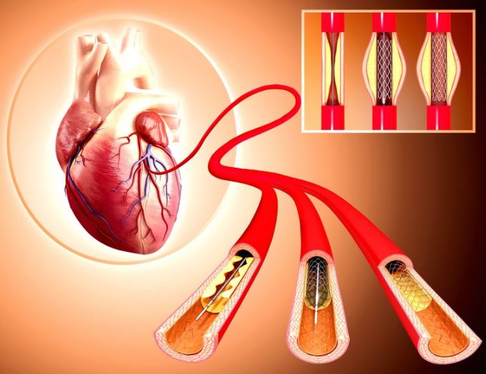 PTCA – Angioplasty with Stenting - Sagar Hospitals